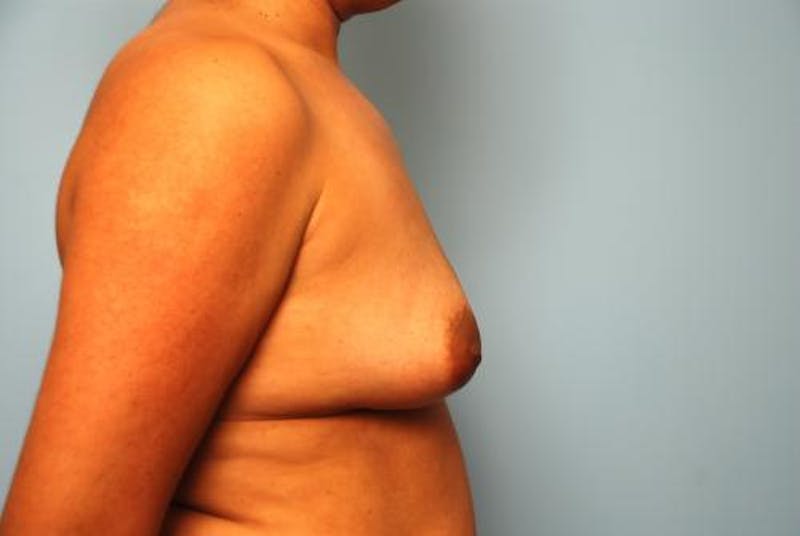 Breast Lift with Augmentation Before & After Gallery - Patient 587408 - Image 5
