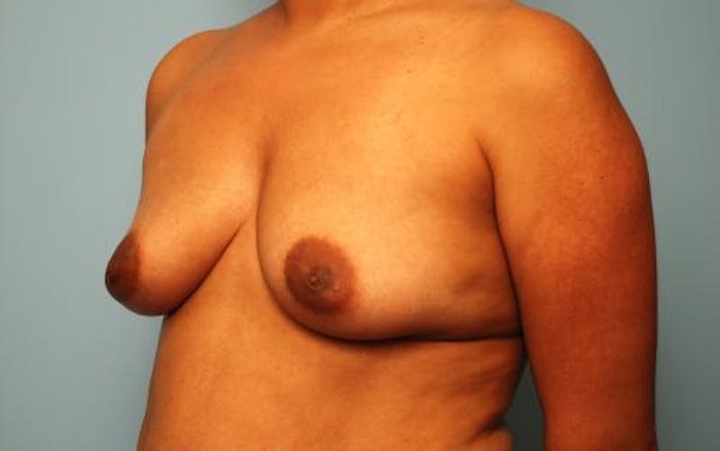 Breast Lift with Augmentation Before & After Gallery - Patient 587408 - Image 7