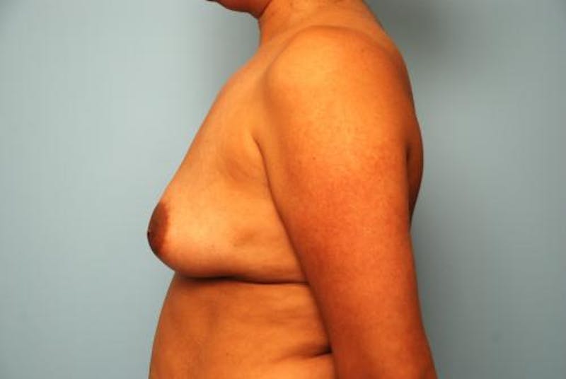 Breast Lift with Augmentation Before & After Gallery - Patient 587408 - Image 9