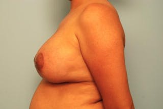 Breast Lift with Augmentation Before & After Gallery - Patient 587408 - Image 10