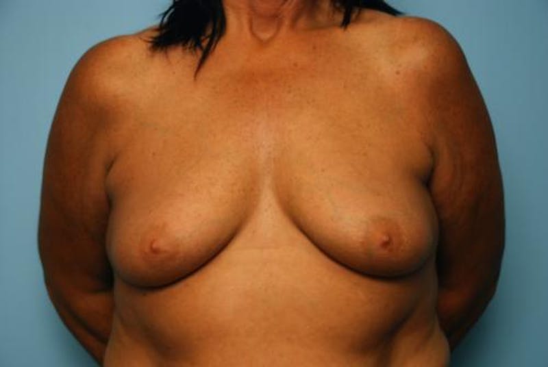 Breast Lift with Augmentation Before & After Gallery - Patient 356946 - Image 1
