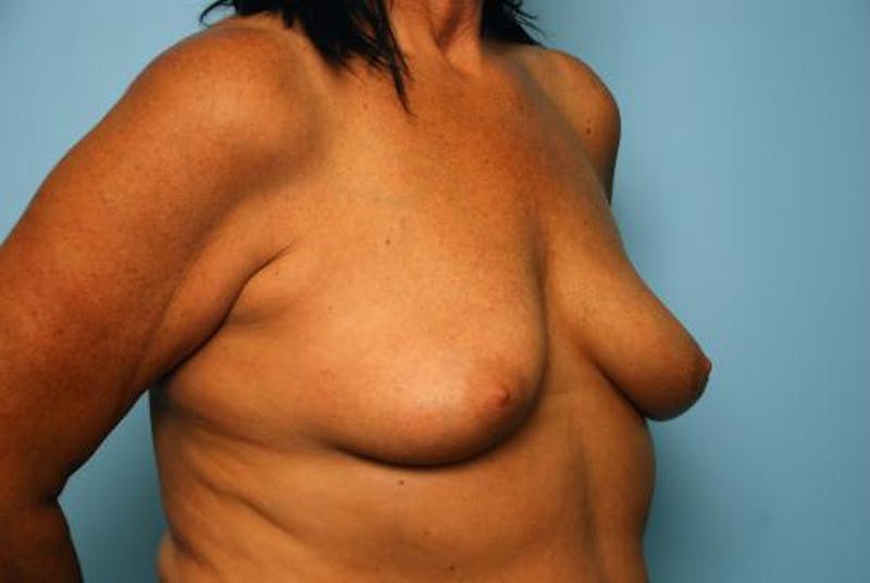 Breast Lift with Augmentation Before & After Gallery - Patient 356946 - Image 3