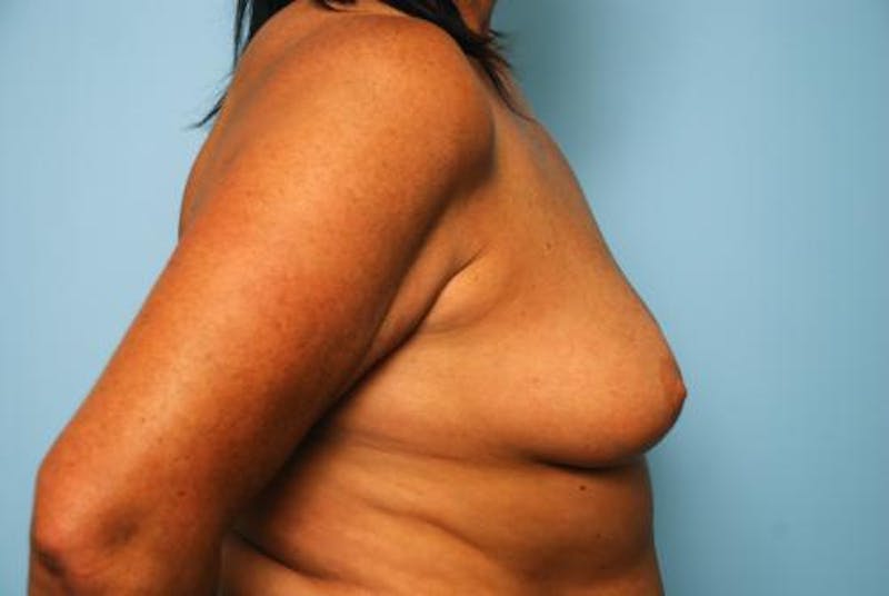 Breast Lift with Augmentation Before & After Gallery - Patient 356946 - Image 5