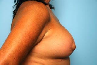 Breast Lift with Augmentation Before & After Gallery - Patient 356946 - Image 6
