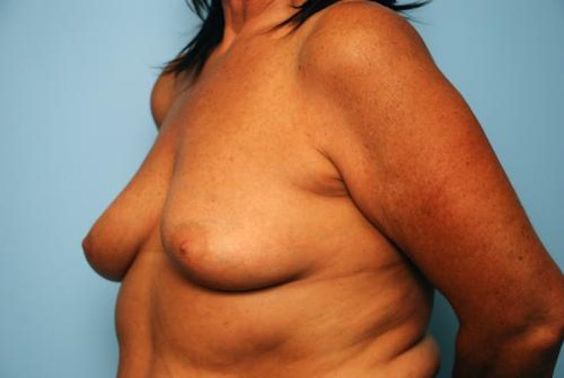 Breast Lift with Augmentation Before & After Gallery - Patient 356946 - Image 7