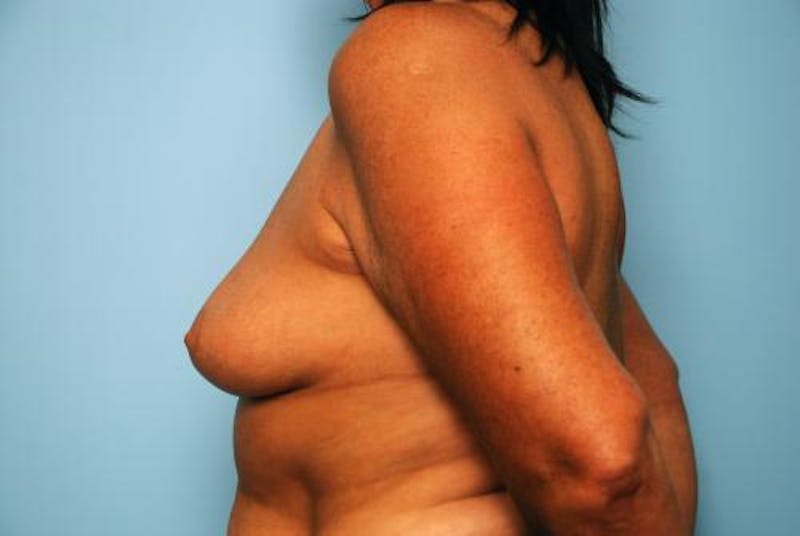 Breast Lift with Augmentation Before & After Gallery - Patient 356946 - Image 9