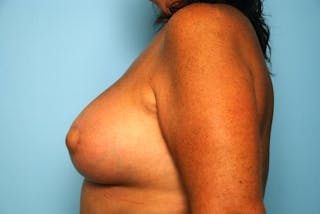 Breast Lift with Augmentation Before & After Gallery - Patient 356946 - Image 10