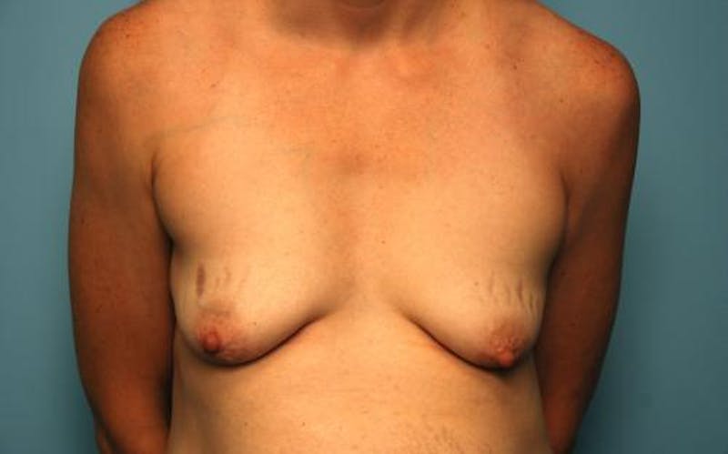 Breast Lift with Augmentation Before & After Gallery - Patient 426646 - Image 1