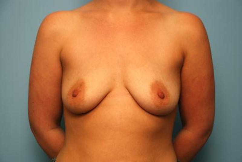 Breast Lift with Augmentation Before & After Gallery - Patient 172449 - Image 1