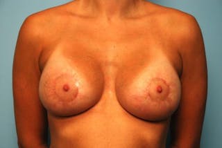 Breast Lift with Augmentation Before & After Gallery - Patient 286111 - Image 2