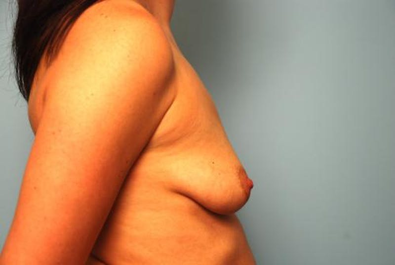 Breast Lift with Augmentation Before & After Gallery - Patient 286111 - Image 5