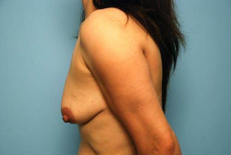 Breast Lift with Augmentation Before & After Gallery - Patient 406629 - Image 9
