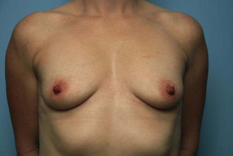 Breast Lift with Augmentation Before & After Gallery - Patient 307930 - Image 1