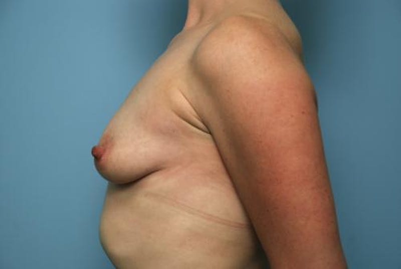 Breast Lift with Augmentation Before & After Gallery - Patient 307930 - Image 7