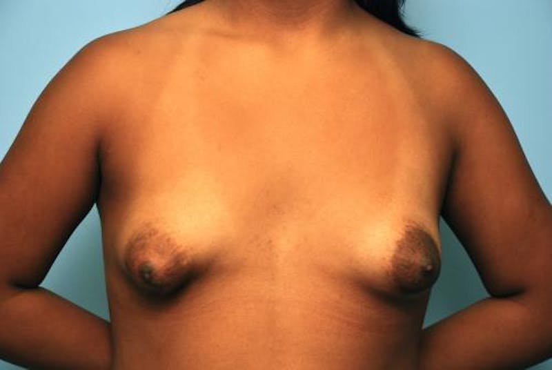 Tubular Breast Deformity Before & After Gallery - Patient 151211 - Image 1