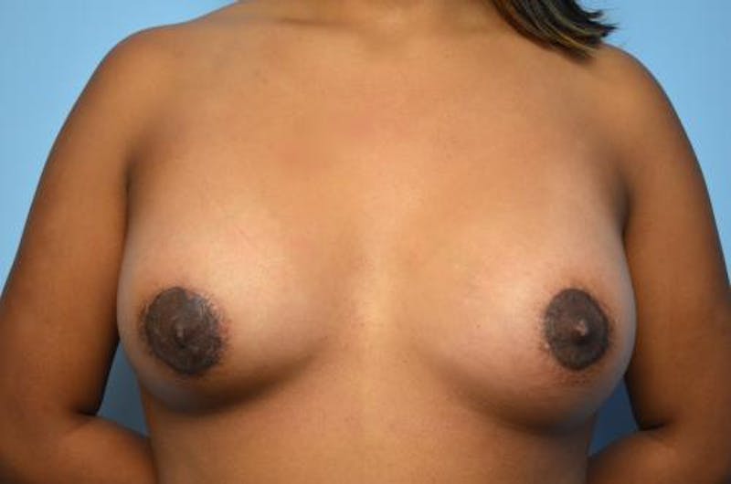 Tubular Breast Deformity Before & After Gallery - Patient 151211 - Image 2