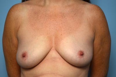 Breast Lift with Augmentation Before & After Gallery - Patient 337142 - Image 1