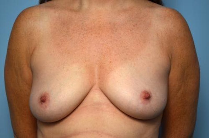 Breast Lift with Augmentation Before & After Gallery - Patient 337142 - Image 1