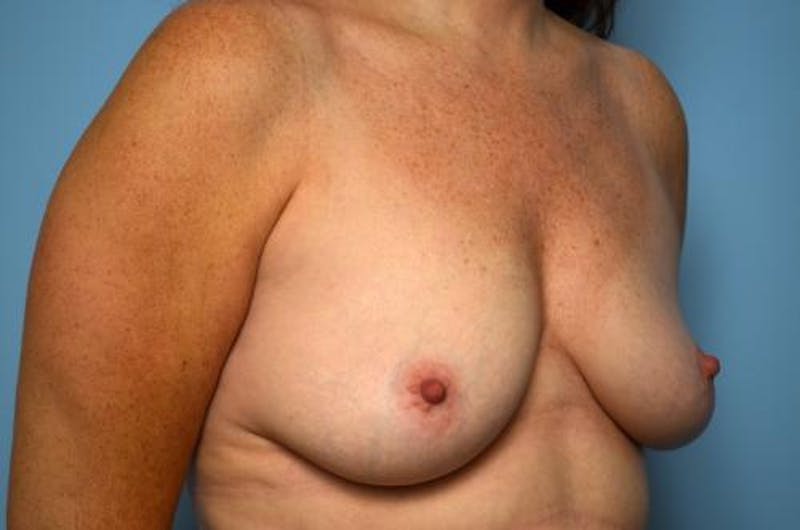 Breast Lift with Augmentation Before & After Gallery - Patient 337142 - Image 3