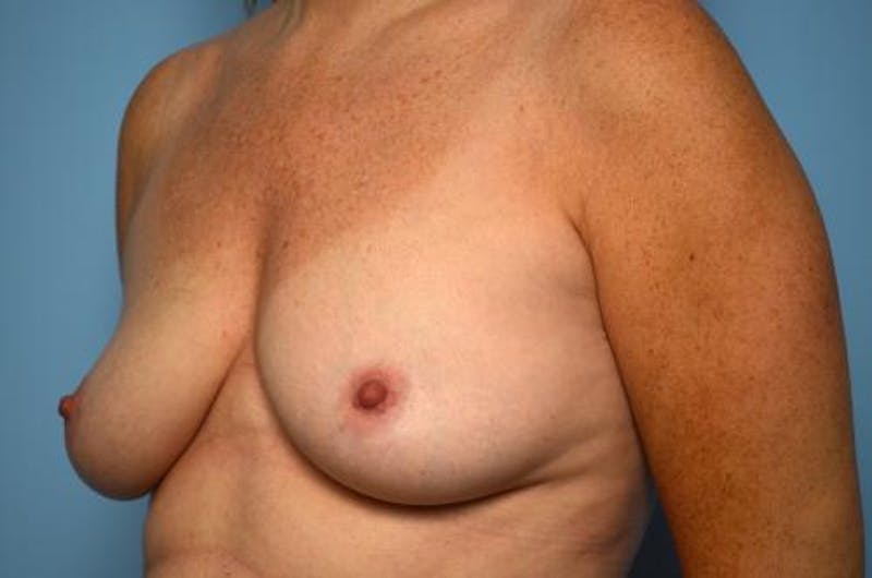 Breast Lift with Augmentation Before & After Gallery - Patient 337142 - Image 7
