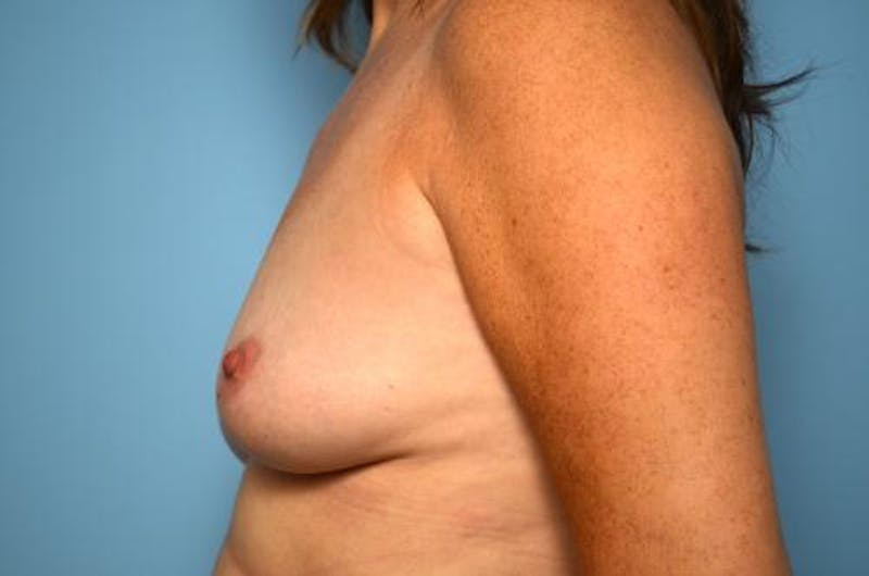 Breast Lift with Augmentation Before & After Gallery - Patient 337142 - Image 9