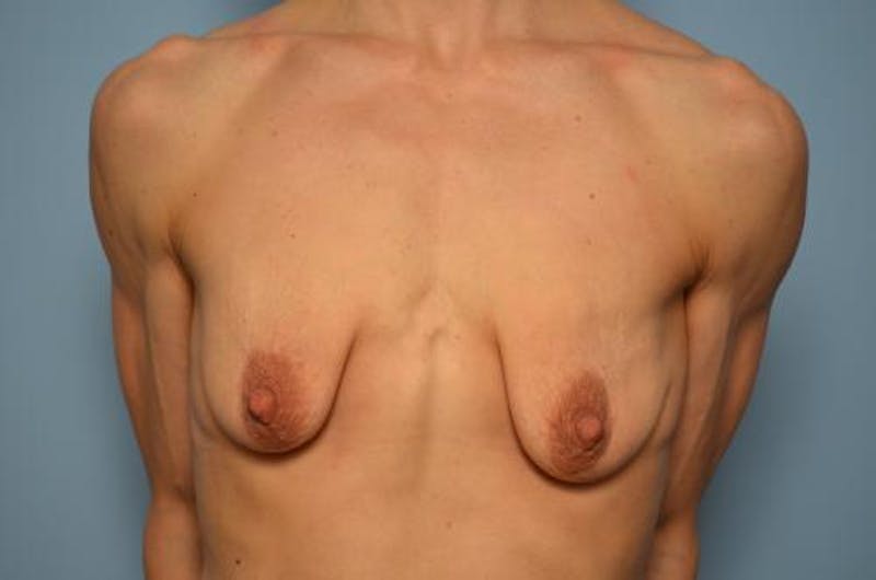Breast Lift with Augmentation Before & After Gallery - Patient 219954 - Image 1