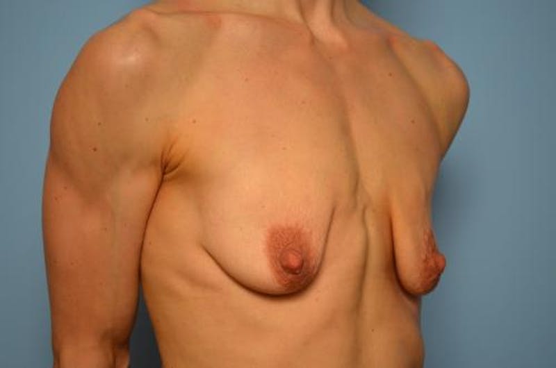 Breast Lift with Augmentation Before & After Gallery - Patient 219954 - Image 3