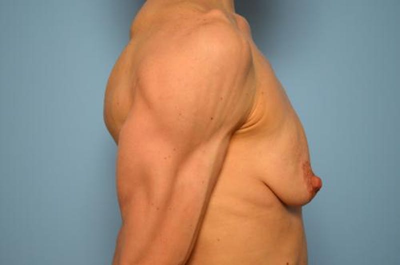 Breast Lift with Augmentation Before & After Gallery - Patient 219954 - Image 5
