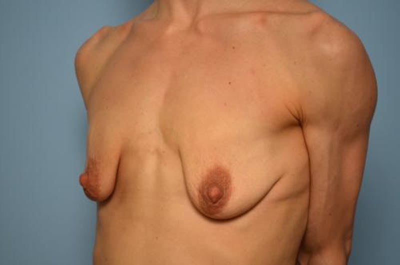 Breast Lift with Augmentation Before & After Gallery - Patient 219954 - Image 7