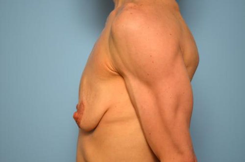 Breast Lift with Augmentation Before & After Gallery - Patient 219954 - Image 9