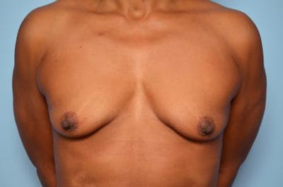 Breast Lift with Augmentation Before & After Gallery - Patient 263975 - Image 1