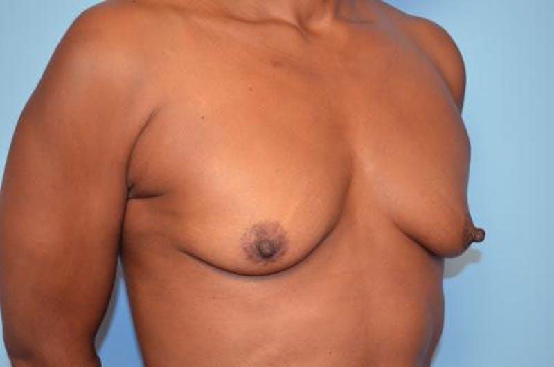Breast Lift with Augmentation Before & After Gallery - Patient 263975 - Image 3