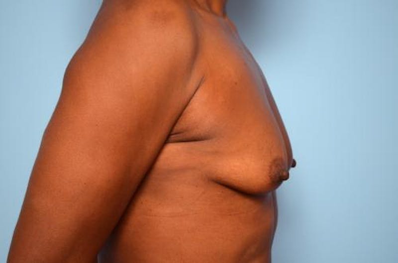 Breast Lift with Augmentation Before & After Gallery - Patient 263975 - Image 5