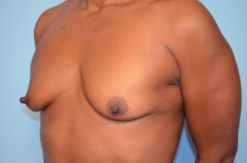 Breast Lift with Augmentation Before & After Gallery - Patient 263975 - Image 7