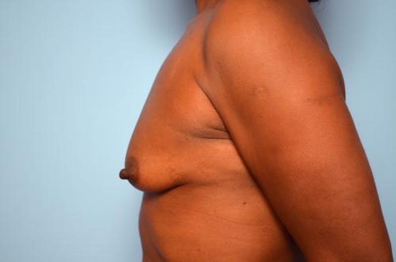 Breast Lift with Augmentation Before & After Gallery - Patient 263975 - Image 9