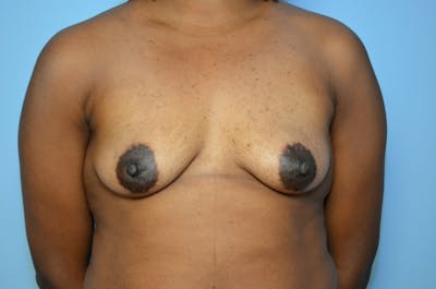 Breast Lift with Augmentation Before & After Gallery - Patient 189237 - Image 1