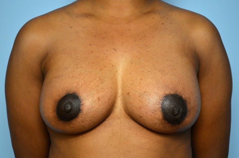 Breast Lift with Augmentation Before & After Gallery - Patient 189237 - Image 2