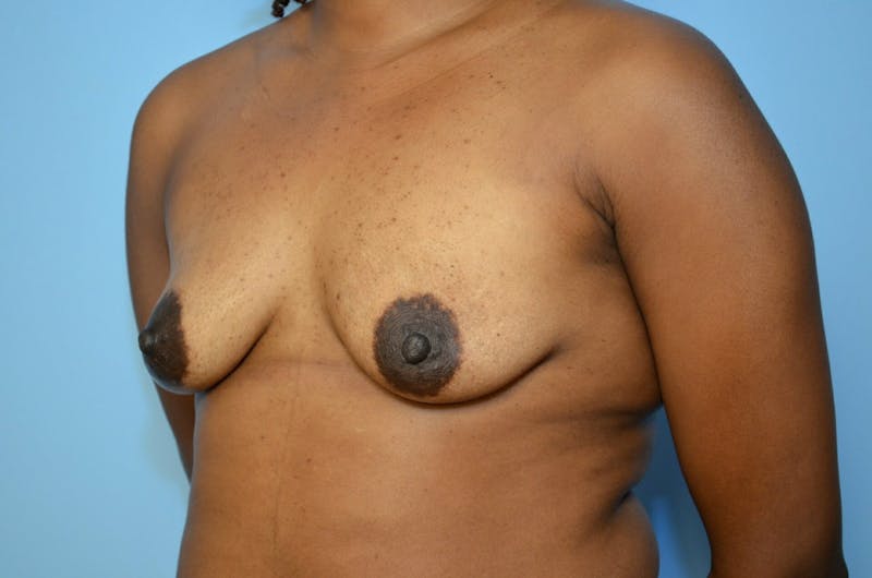 Breast Lift with Augmentation Before & After Gallery - Patient 189237 - Image 7