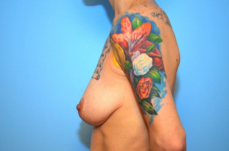 Breast Lift with Augmentation Before & After Gallery - Patient 299756 - Image 9
