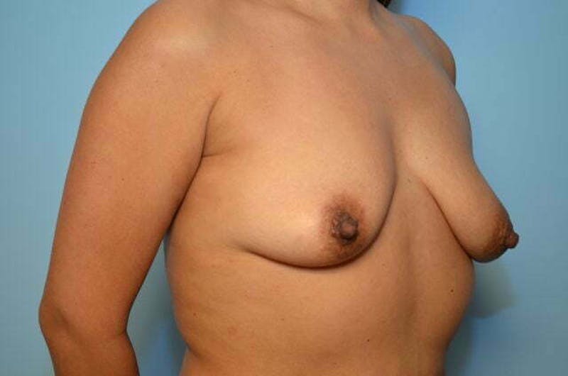 Breast Lift with Augmentation Before & After Gallery - Patient 314366 - Image 3
