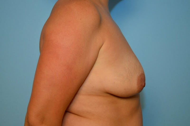 Breast Lift with Augmentation Before & After Gallery - Patient 255052 - Image 5