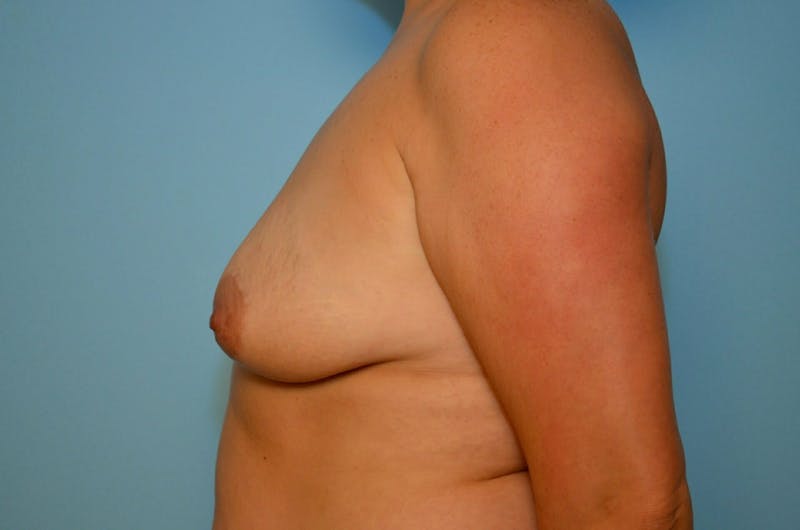 Breast Lift with Augmentation Before & After Gallery - Patient 255052 - Image 9