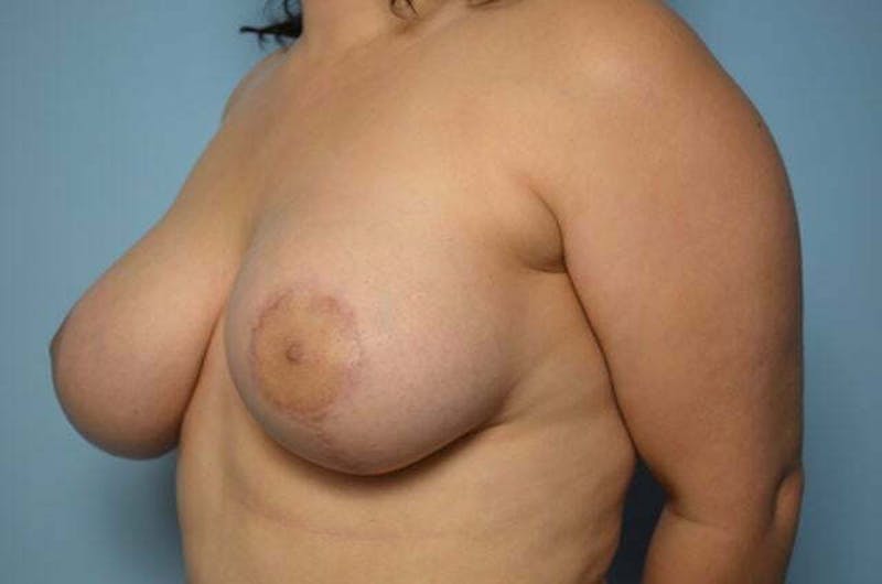Breast Lift with Augmentation Before & After Gallery - Patient 275054 - Image 8