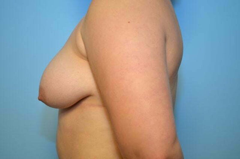 Breast Lift with Augmentation Before & After Gallery - Patient 275054 - Image 9