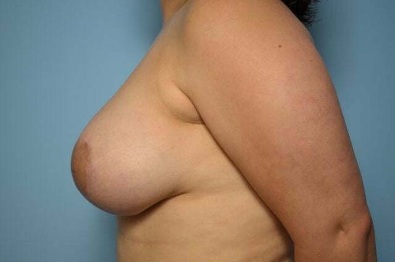 Breast Lift with Augmentation Before & After Gallery - Patient 275054 - Image 10