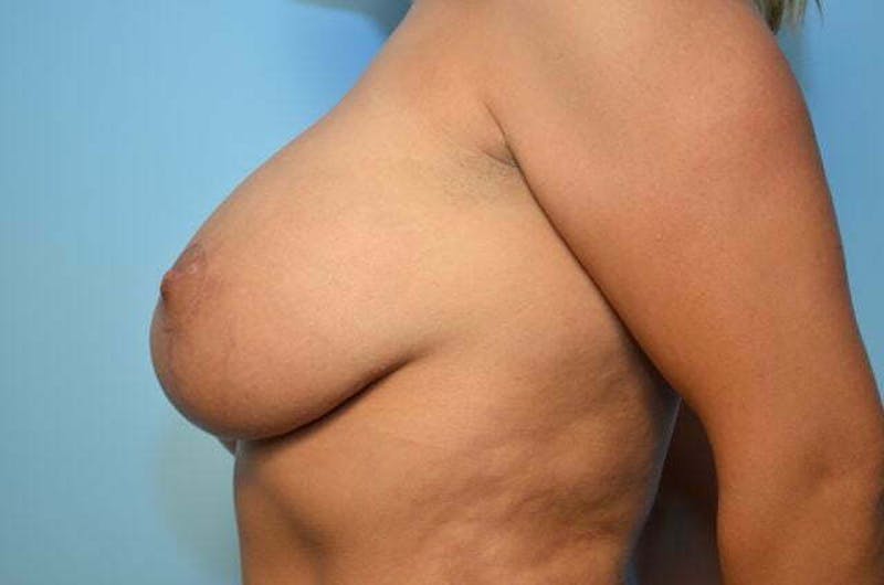 Breast Lift with Augmentation Before & After Gallery - Patient 243974 - Image 10