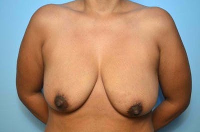 Breast Lift with Augmentation Before & After Gallery - Patient 870058 - Image 1