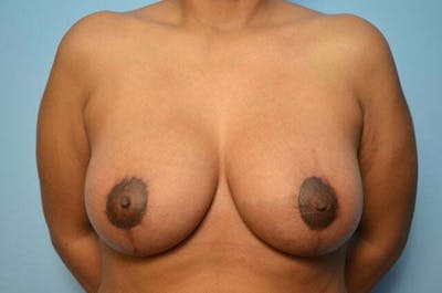 Breast Lift with Augmentation Before & After Gallery - Patient 870058 - Image 2