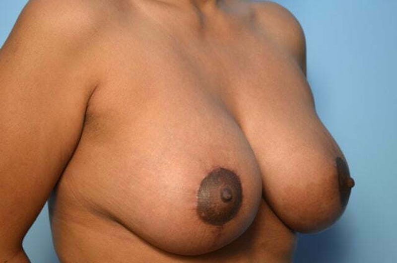 Breast Lift with Augmentation Before & After Gallery - Patient 870058 - Image 4