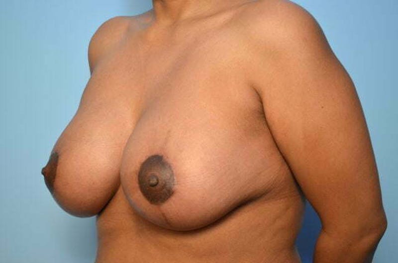 Breast Lift with Augmentation Before & After Gallery - Patient 870058 - Image 8
